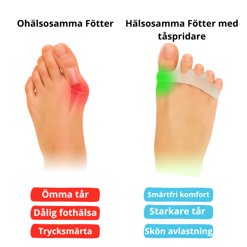 ToePlus Tåspridare – Lindrar värk, korrigerar tår och förbättrar fotens balans